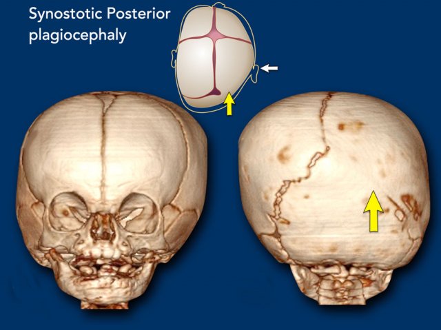 posterior plagiocephaly