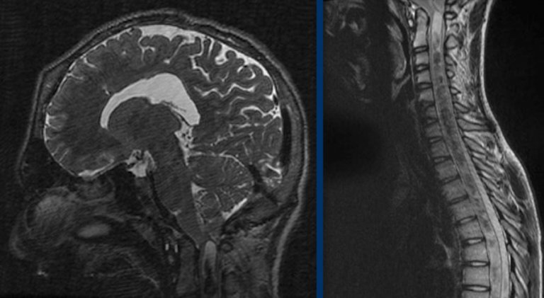 The Radiology Assistant : Craniosynostosis