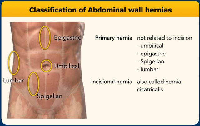 The Radiology Assistant : Abdominal wall hernias