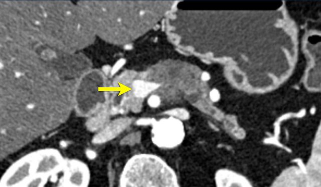 Teardrop sign. A large tumor in the body of the pancreas, 90 – 180 degrees contact with the SMV, but moreover deformation of the SMV into a so called teardrop, highly suspicious for invasion.