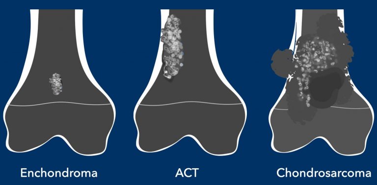 The Radiology Assistant : Cartilage tumors