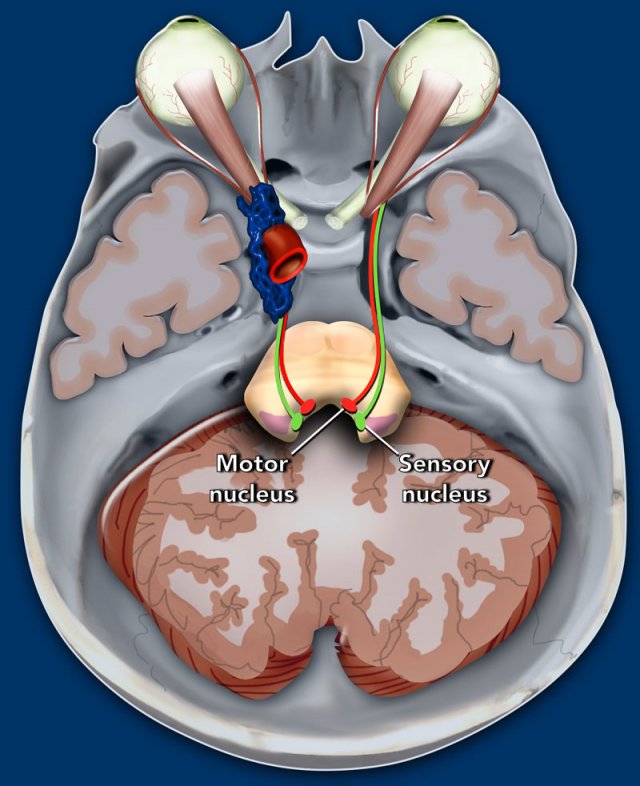 trigeminal nerve mri sagittal