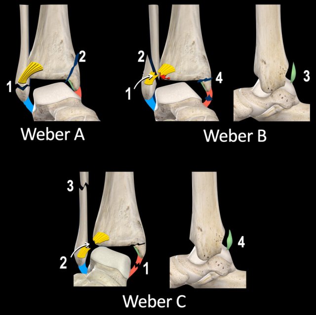 The Radiology Assistant Algoritm For Ankle Fractures 2 0 The Radiology Assistant Algoritm For Ankle Fractures 2 0
