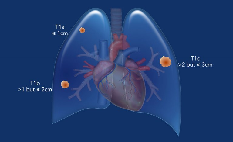 Tnm R The Radiology Assistant : TNM classification 9ᵗʰ edition