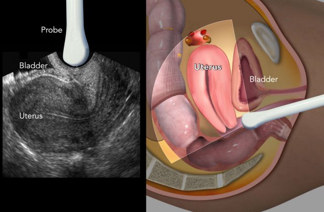 Probe orientation in TVUS