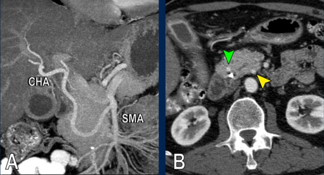 Anomalous common hepatic artery originates from the SMA.