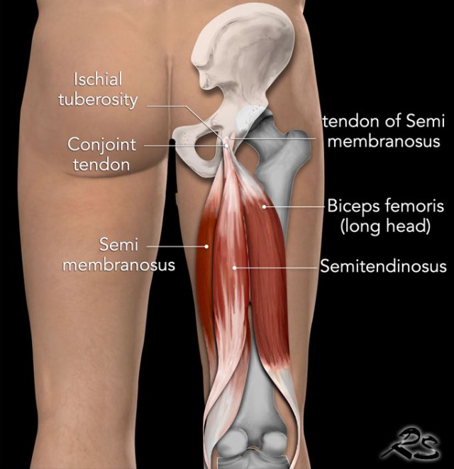 The Radiology Assistant : Hamstring injury