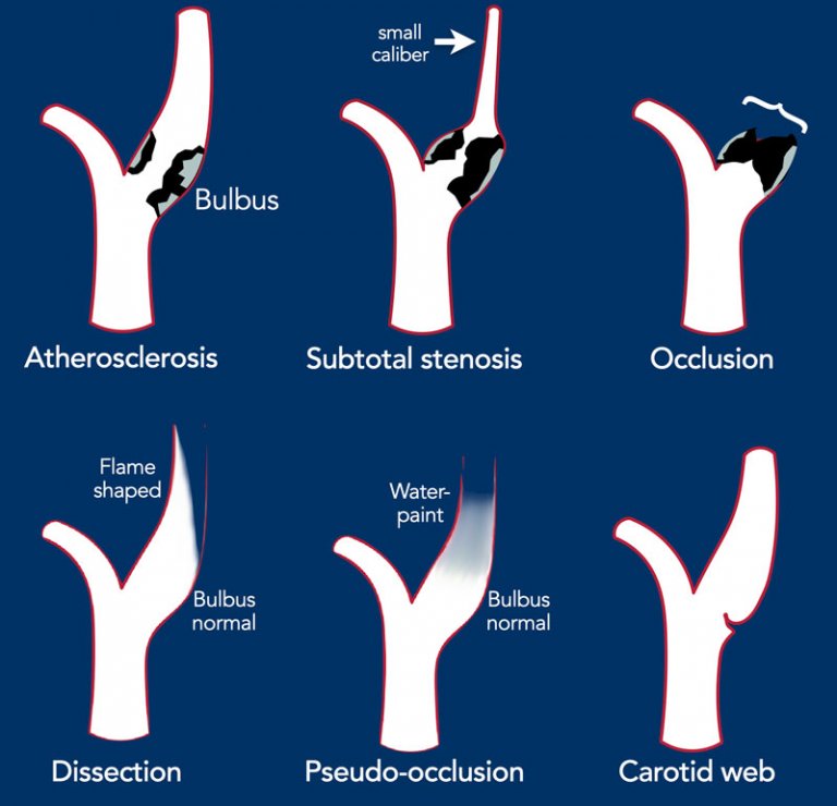 The Radiology Assistant : How to Differentiate Carotid Obstructions