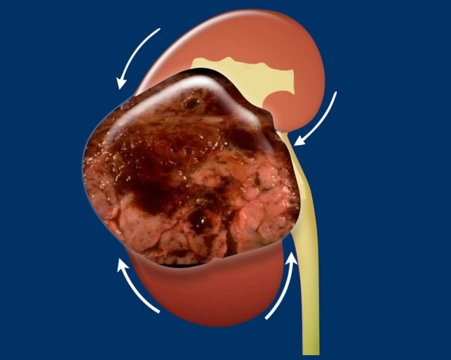 Claw sign in renal tumor