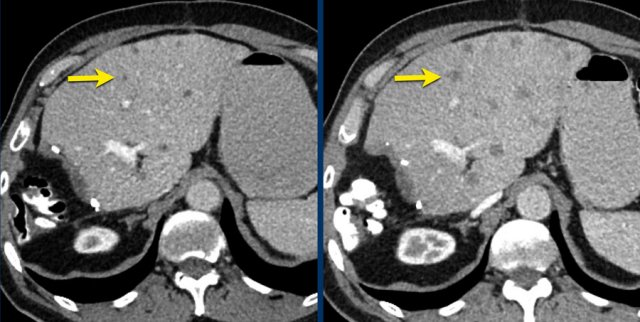 CT images in a 61-year-old male with unequivocal progression of non-target lymphogenic metastases of melanoma during treatment.