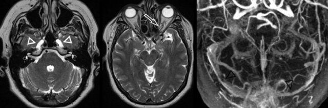 Intracranial hypertension with enlarged Meckel cave (left image, white arrowheads), prominent subarachnoid space around the optic nerve (middle image, white arrow) and bilateral venous sinus stenosis (right image, black arrowheads)