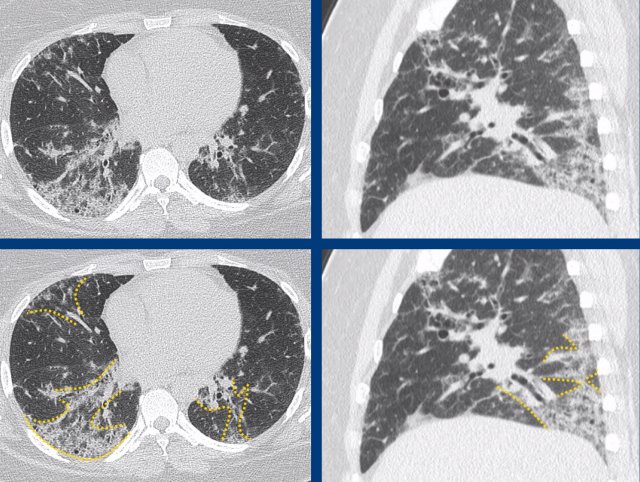 NSIP in Sjögren’s disease