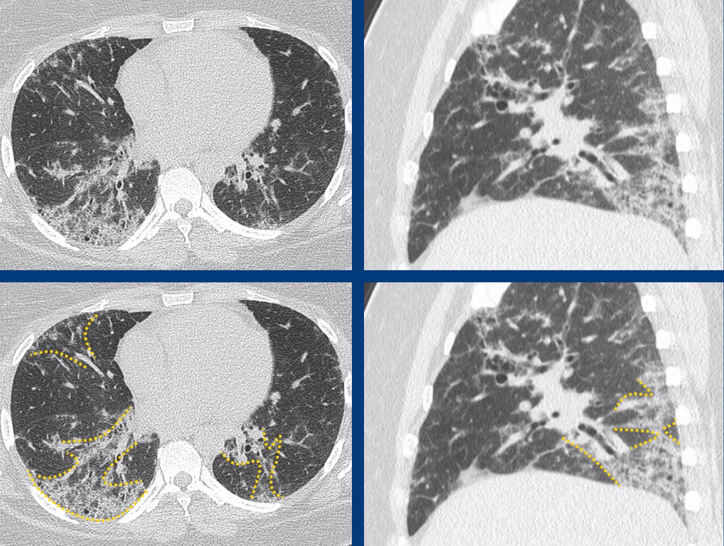 The Radiology Assistant : HRCT – Patterns of pulmonary fibrosis in ILD
