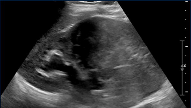 kidney ultrasound tumor