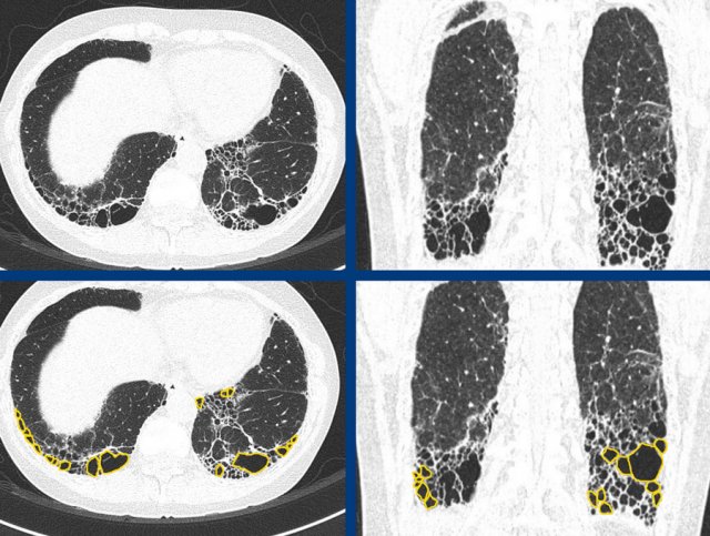 UIP pattern in Rheumatoid Arthritis