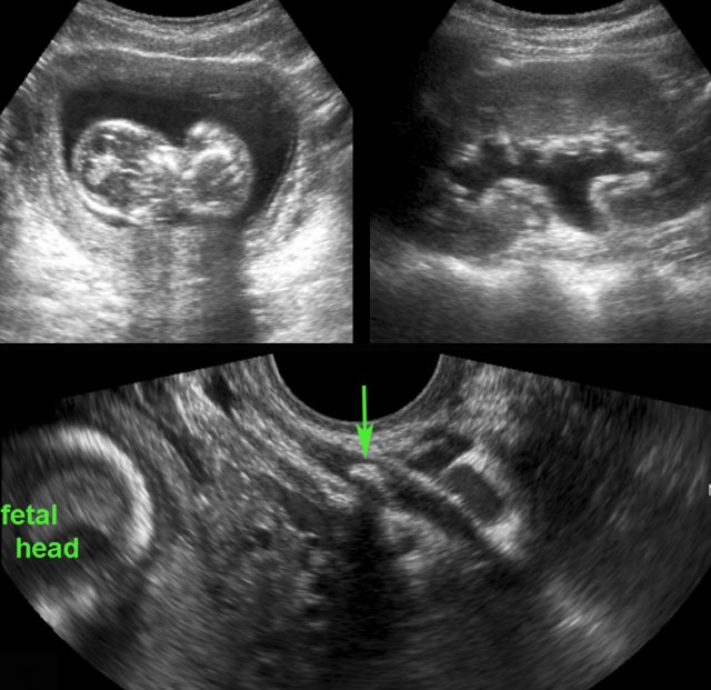 TVUS shows distal ureteric stone in pregnant patient with acute LLQ pain.