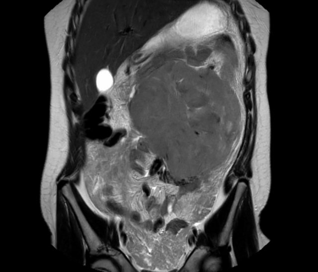 a) A 12-year-old boy presented with a large chest wall mass, later