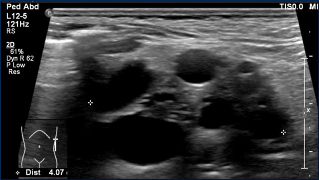 kidney ultrasound tumor