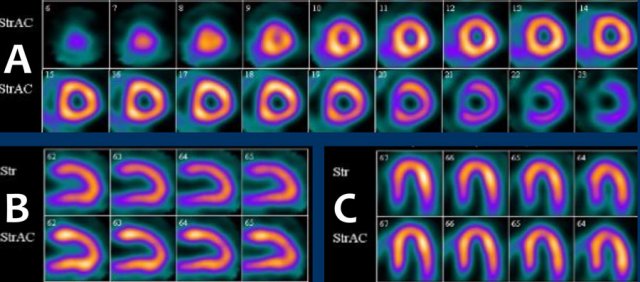 Myocardial SPECT attenuation corrected (AC) images during stress showing no perfusion defect. A: apex to base; B: septum to lateral wall; C: inferior to anterior