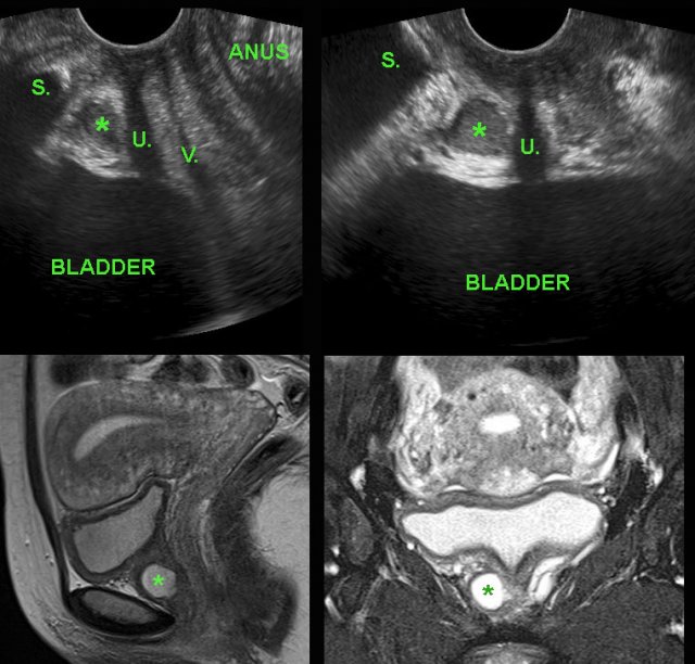 urethral diverticulum ultrasound