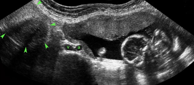 Intermittent torsion of dermoid cyst during pregnancy. a and v = right iliac artery and vein)