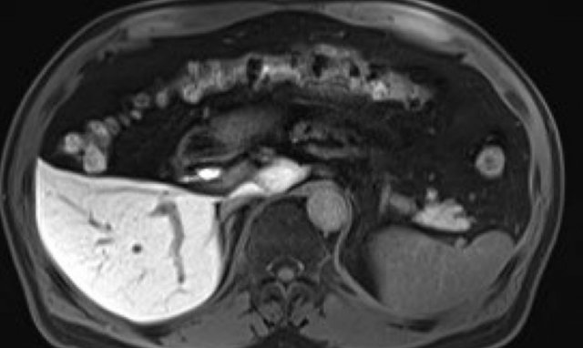 Hepatobiliary phase study: diffuse uptake of contrast by normal liver parenchyma with hypointense appearance of the vessels and contrast excreted within the bile ducts.