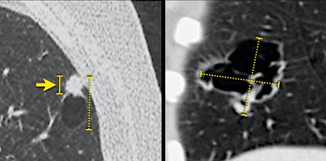 Possible overestimation of tumour burden due to inclusion of the cystic air space component in the total lesion size, when measured according to TNM 8th edition (stippled lines). The solid line (left panel) may better represent the invasive tumour component and associated prognosis.