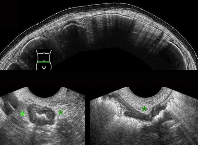 TVUS detects small sigmoid CA in patient with massive colonic obstruction.