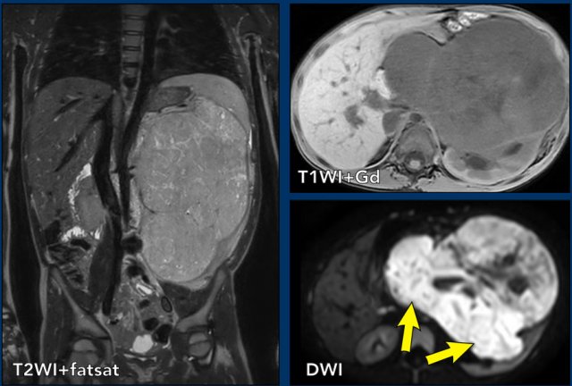 Teenager with right flank pain, Pediatric Radiology Case, Pediatric  Imaging