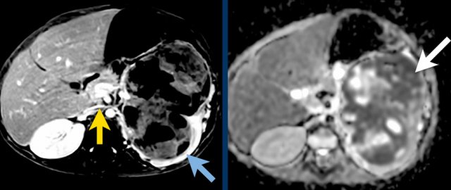 A. The tumor enhances less than the peripheral remnant of normal renal tissue (blue arrow). The left renal vein is open (yellow arrow). Solid parts of the tumor show diffusion restriction (white arrow)