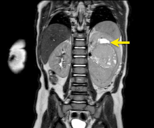 Abdominal x ray reveals a calcified round body in right lower quadrant