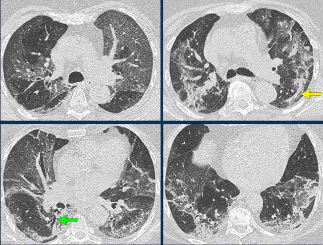 COVID-19 infection - late phase