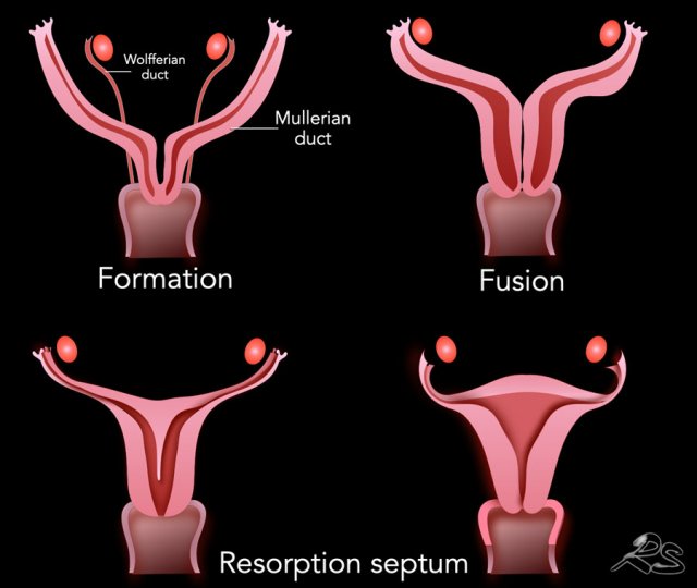 mullerian agenesis ultrasound