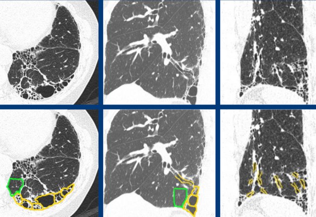 pulmonary fibrosis