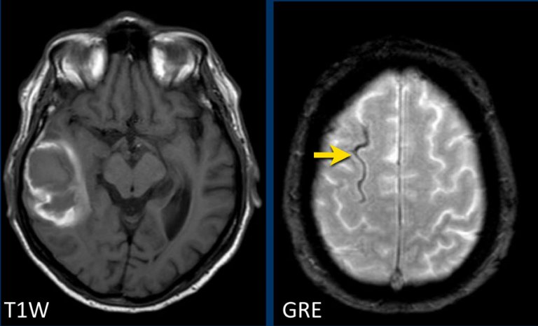 The Radiology Assistant : Non-traumatic Intracranial Hemorrhage