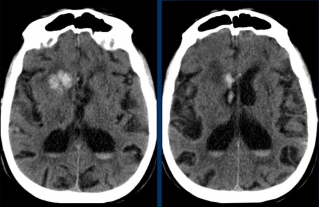 Hemorrhage in the head of the caudate nucleus with extension into the ventricular system