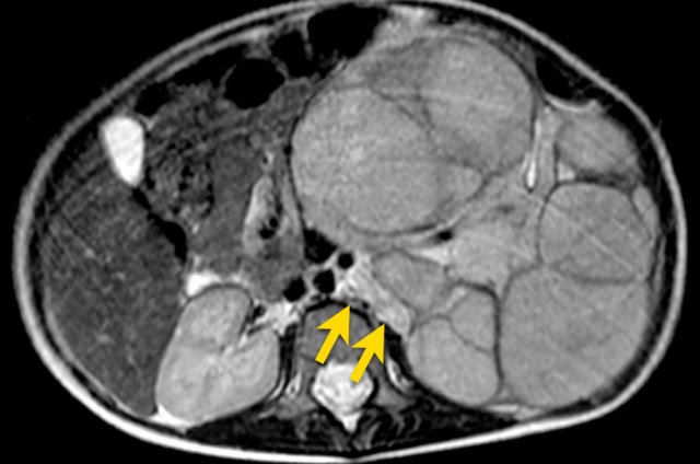 Left sided nephroblastoma in a two-year-old girl. Note the para-aortal lymph node metastasis (arrow).