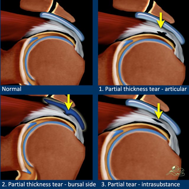 The Radiology Assistant : Shoulder - Rotator cuff injury