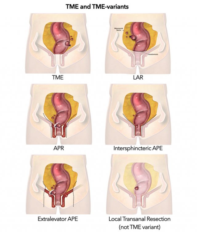 Abdominoperineal Resection Steps 0406