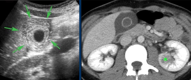 Bacteremia in a patient with lobar nephritis with reactive gallbladder wall thickening simulating acute cholecystitis