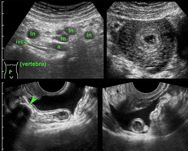 Early acute appendicitis in pregnant patient, shown by TVUS.