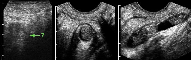 TVUS detects inflamed appendix in deep pelvic location.