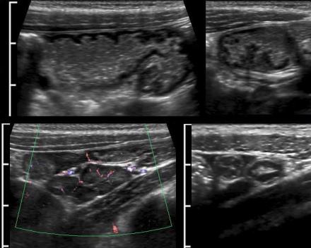 The Radiology Assistant : Ultrasound of the GI tract - Normal Anatomy