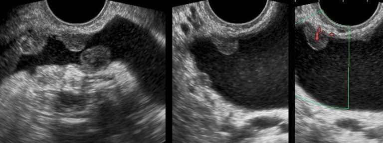 The Radiology Assistant : Transvaginal Ultrasound for Non ...