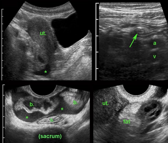 Early PID with secondary thickened appendix. (ut. = uterus, b = small bowel, a and v = iliac artery and vein, s = sigmoid)
