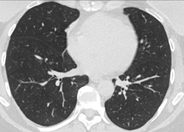 CO-RADS 1. Normal chest CT.