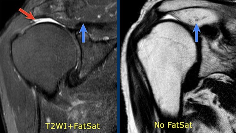 The Radiology Assistant : Shoulder - Rotator cuff injury