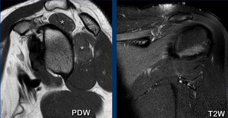 Shoulder Rtc Syndrome The Radiology Assistant : Shoulder Rotator cuff injury