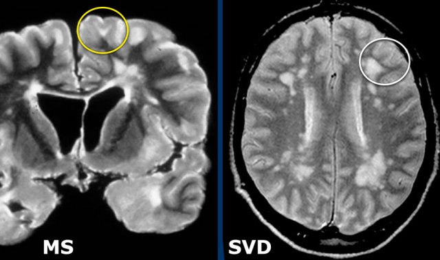 Multiple sclerosis | Radiology Reference Article | Radiopaedia.org