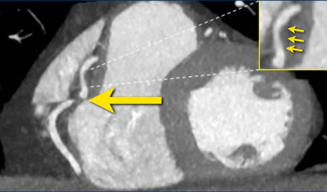 Cad-Rads N: Stair-step artefact (large arrow) in combination with mild stenosis in proximal RCA (small arrows).